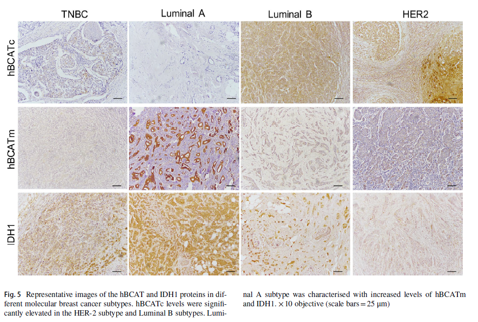 Images of hBCAT and IDH1 proteins in different molecular breast cancer subtypes. 